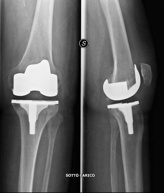 artrosi del ginochio3