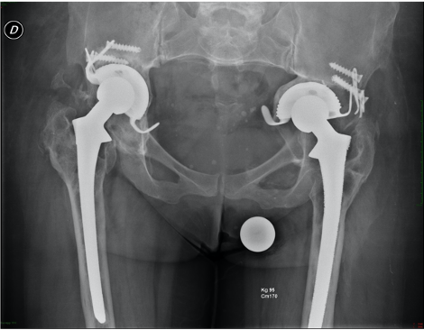 immagine protesi anca